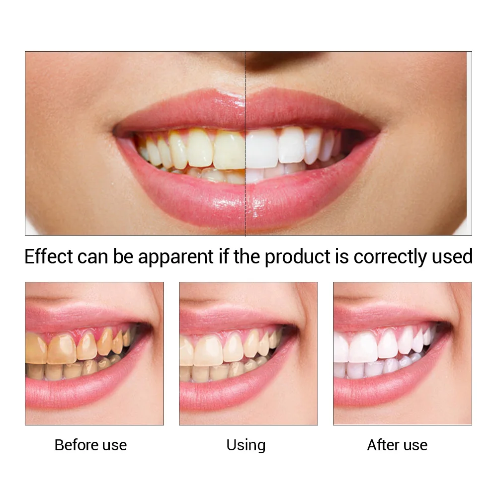 FTEENPLY Essência para claream - Teeth Whitening Ulta avaliação e preço