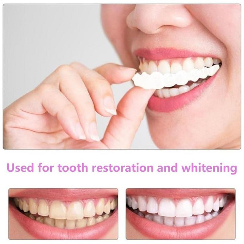 Encaixe em folheados de dentes - Teeth Whitening Veneers avaliação e preço
