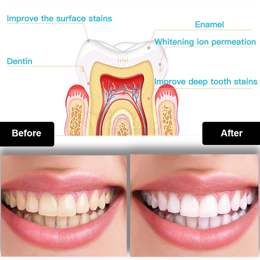 Kit de clareamento dental dos  - Teeth Whitening Ulta avaliação e preço